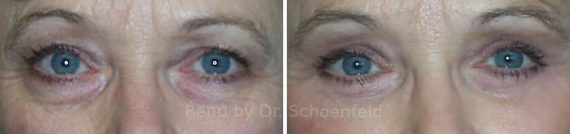 Blepharoplasty Before and After Photos in DC, Patient 7276