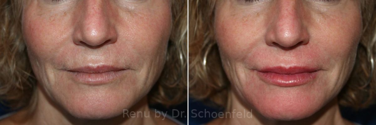 Dermal Filler Before and After Photos in DC, Patient 7399