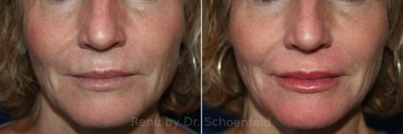 Dermal Filler Before and After Photos in DC, Patient 7399