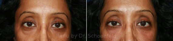 Dermal Filler Before and After Photos in DC, Patient 7402