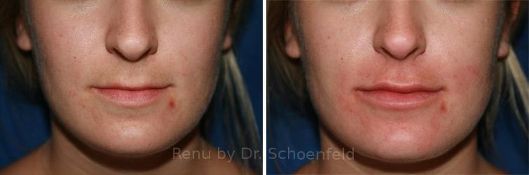 Dermal Filler Before and After Photos in DC, Patient 7357