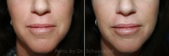 Dermal Filler Before and After Photos in DC, Patient 8377