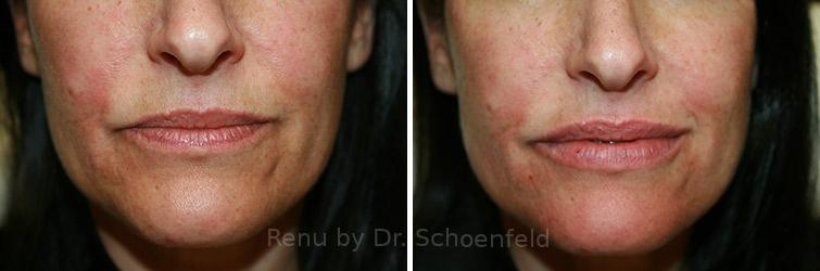 Dermal Filler Before and After Photos in DC, Patient 7343