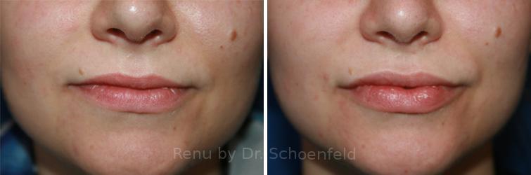 Dermal Filler Before and After Photos in DC, Patient 7387