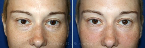 Dermal Filler Before and After Photos in DC, Patient 7393