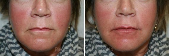 Dermal Filler Before and After Photos in DC, Patient 7363