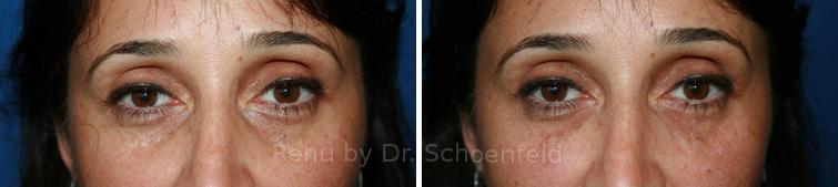 Dermal Filler Before and After Photos in DC, Patient 7369