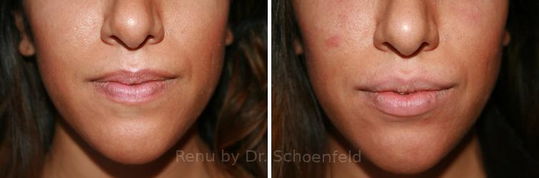 Dermal Filler Before and After Photos in DC, Patient 7372