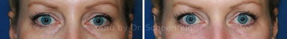 Dermal Filler Before and After Photos in DC, Patient 7375