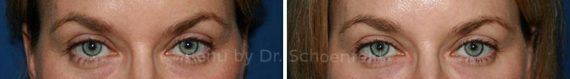 Dermal Filler Before and After Photos in DC, Patient 7381