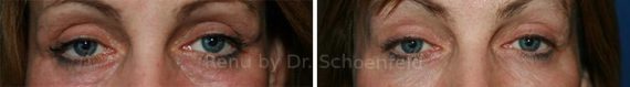 Dermal Filler Before and After Photos in DC, Patient 7378