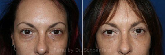 Dermal Filler Before and After Photos in DC, Patient 7396