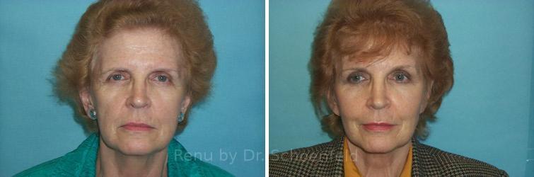 Facelift Before and After Photos in DC, Patient 7431