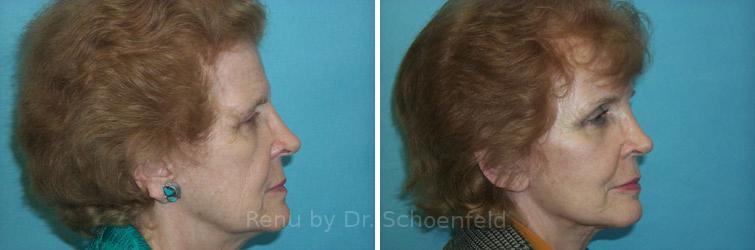 Facelift Before and After Photos in DC, Patient 7431