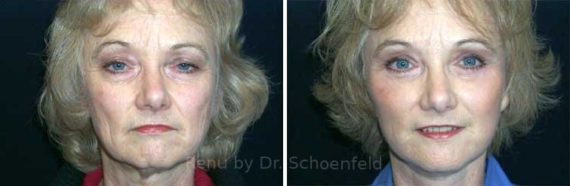 Facelift Before and After Photos in DC, Patient 7436