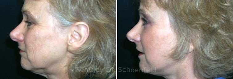 Facelift Before and After Photos in DC, Patient 7436