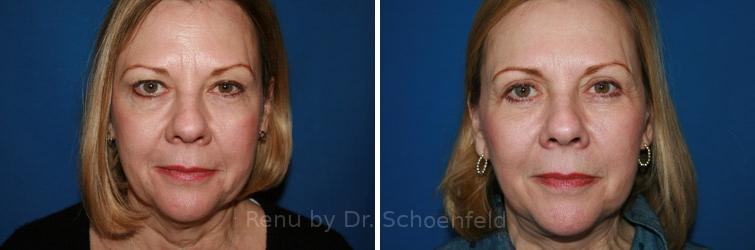 Facelift Before and After Photos in DC, Patient 7441