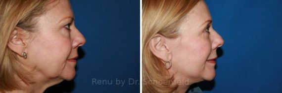 Facelift Before and After Photos in DC, Patient 7441