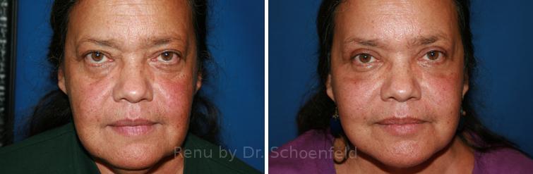 Facelift Before and After Photos in DC, Patient 7446