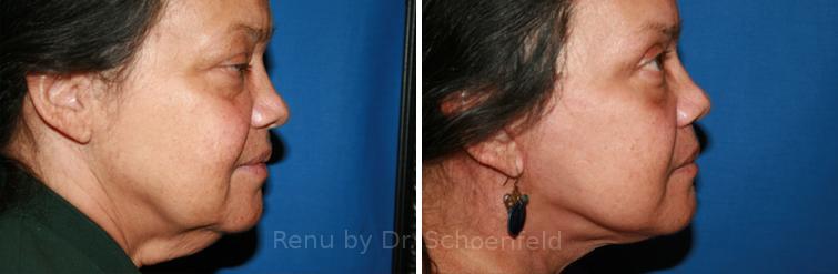 Facelift Before and After Photos in DC, Patient 7446