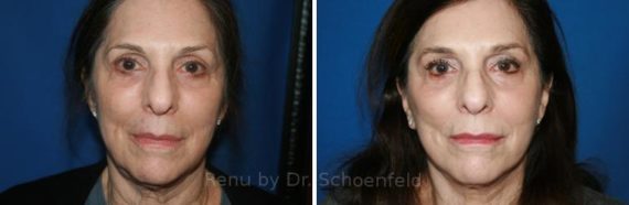 Facelift Before and After Photos in DC, Patient 7451