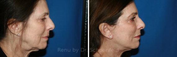 Facelift Before and After Photos in DC, Patient 7451