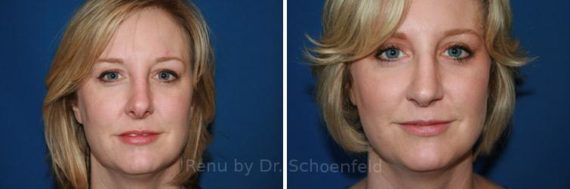 Revision Rhinoplasty Before and After Photos in DC, Patient 7486