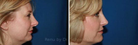 Revision Rhinoplasty Before and After Photos in Chevy Chase, MD