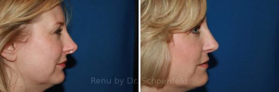 Revision Rhinoplasty Before and After Photos in DC, Patient 7486