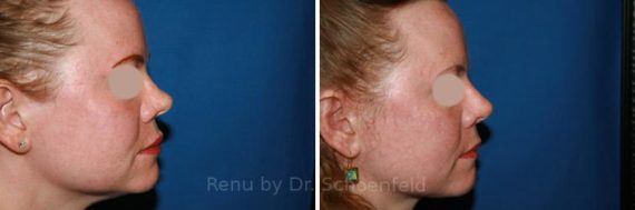 Revision Rhinoplasty Before and After Photos in DC, Patient 7491