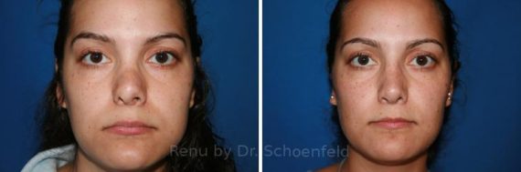 Revision Rhinoplasty Before and After Photos in DC, Patient 7496