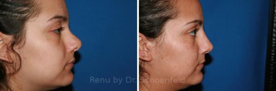 Revision Rhinoplasty Before and After Photos in DC, Patient 7496