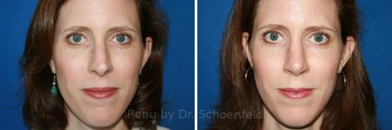 Revision Rhinoplasty Before and After Photos in DC, Patient 7501