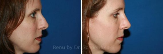 Revision Rhinoplasty Before and After Photos in DC, Patient 7501
