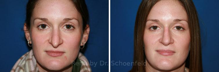 Revision Rhinoplasty Before and After Photos in DC, Patient 7506