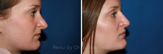 Revision Rhinoplasty Before and After Photos in DC, Patient 7506