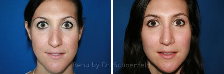 Revision Rhinoplasty Before and After Photos in DC, Patient 7511