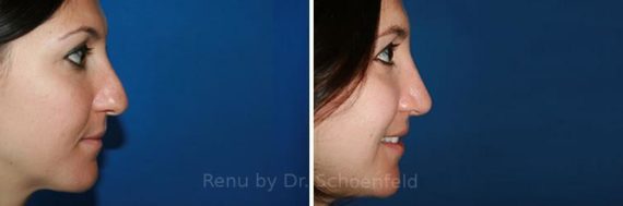 Revision Rhinoplasty Before and After Photos in DC, Patient 7511
