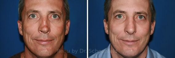 Revision Rhinoplasty Before and After Photos in DC, Patient 7516