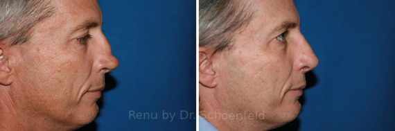Revision Rhinoplasty Before and After Photos in DC, Patient 7516