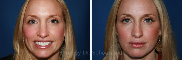 Revision Rhinoplasty Before and After Photos in DC, Patient 7521