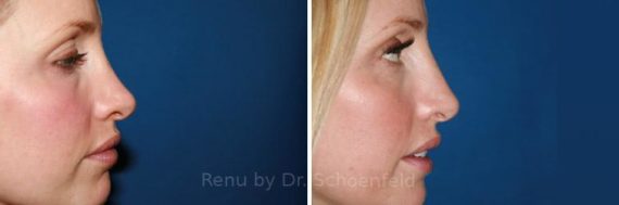 Revision Rhinoplasty Before and After Photos in DC, Patient 7521
