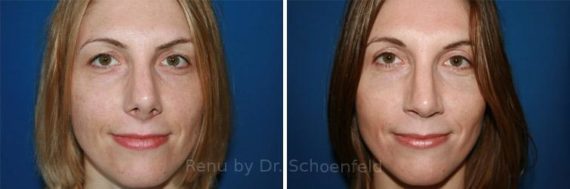 Revision Rhinoplasty Before and After Photos in DC, Patient 7526