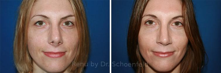 Revision Rhinoplasty Before and After Photos in DC, Patient 7526