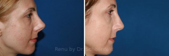 Revision Rhinoplasty Before and After Photos in DC, Patient 7526