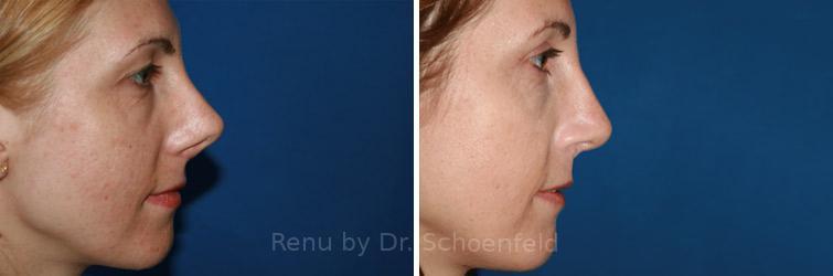 Revision Rhinoplasty Before and After Photos in DC, Patient 7526