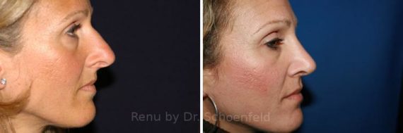 Revision Rhinoplasty Before and After Photos in DC, Patient 7531