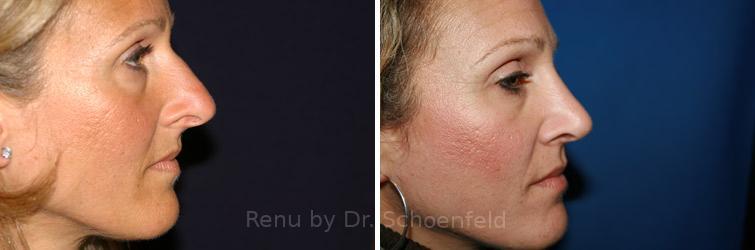 Revision Rhinoplasty Before and After Photos in DC, Patient 7531