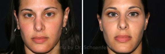 Revision Rhinoplasty Before and After Photos in DC, Patient 7546