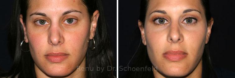 Patient 7546, Revision Rhinoplasty Before and After Photos Revision Rhinoplasty Before and After Photos in DC, Patient 7546